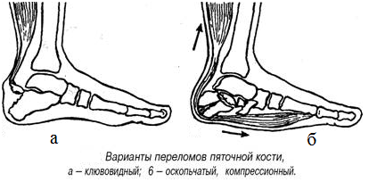 Обувь при переломе пяточной кости