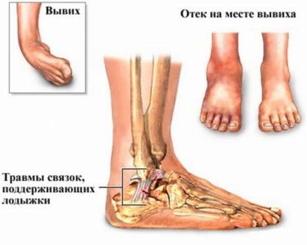 Симптомы вывиха ноги щиколотка