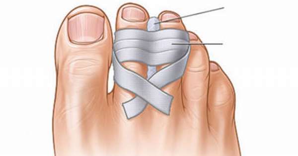 Как наложить гипс при переломе пальца ноги