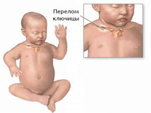 Костная мозоль при переломе ключицы у ребенка