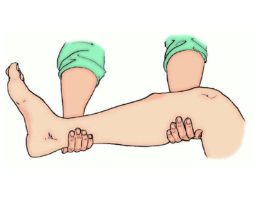 Лечение при переломе голени ноги