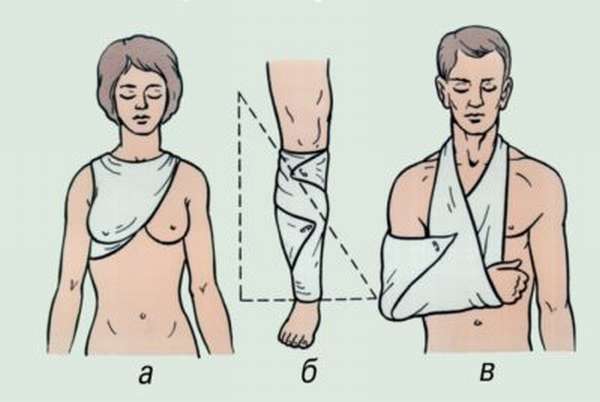 Иммобилизация руки при переломе плеча