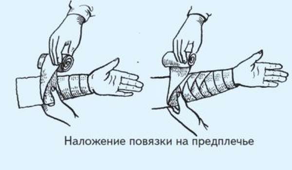 Как забинтовывать руку при переломе