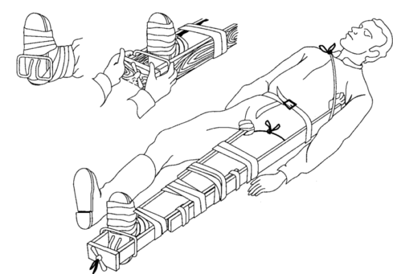 Правила наложения шины дитерихса при переломе бедра