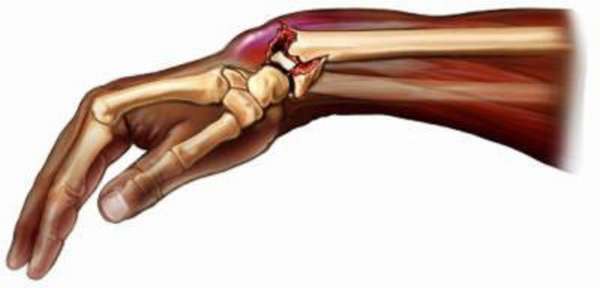 Что такое вколоченный перелом кисти руки