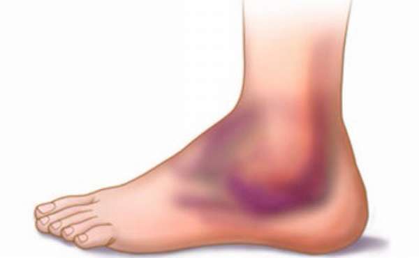 Ушиб ноги гематома последствия