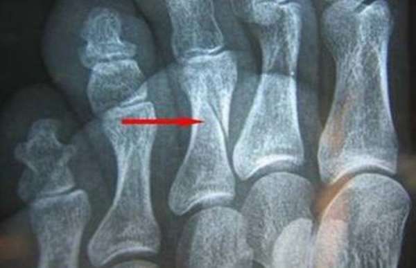 Какие первые признаки перелома пальца на ноге