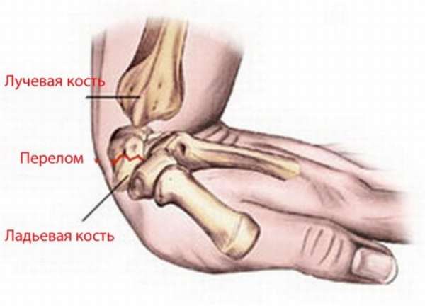 Фото открытого перелома кисти руки