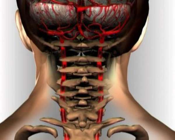 Массаж при синдром позвоночной артерии при шейном остеохондрозе