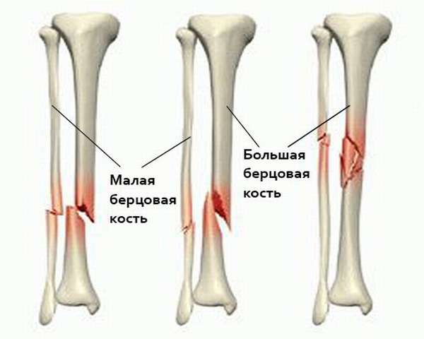 Перелом малоберцовой ноги без смещения