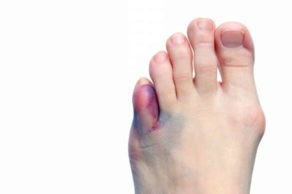 Внутренняя гематома на пальце ноги