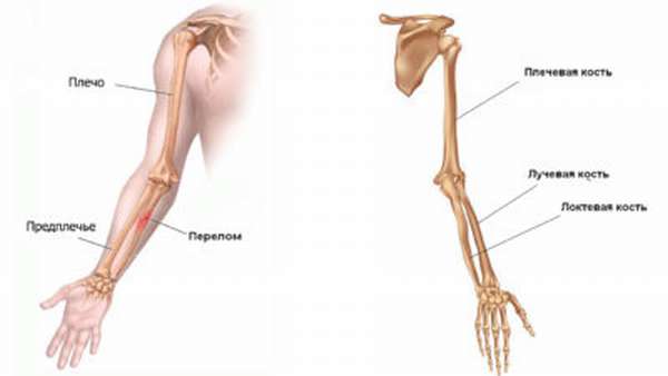 Перелом костей предплечья картинка