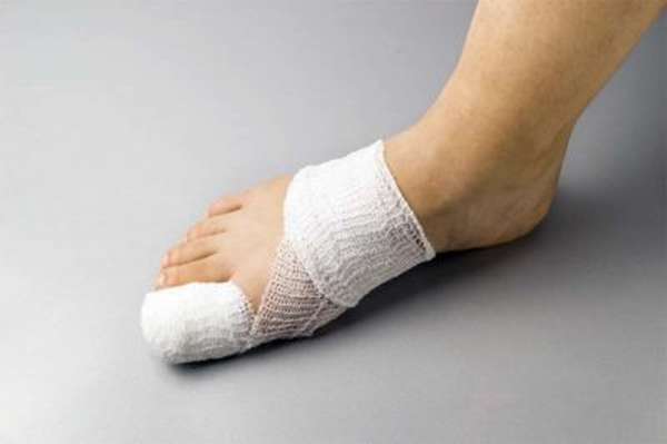 Как наложить гипс при переломе пальца ноги