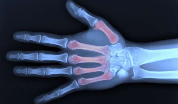 Перелом пястной кости руки симптомы