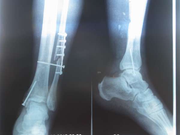 Через сколько снимают гипс с ноги при переломе берцовой кости