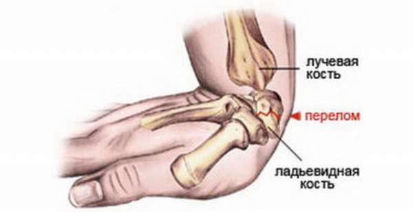 Трещина перелом на руке как лечить