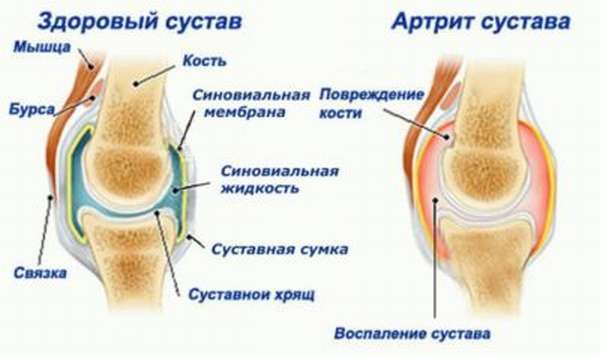 Опухоль колена без ушиба и болит