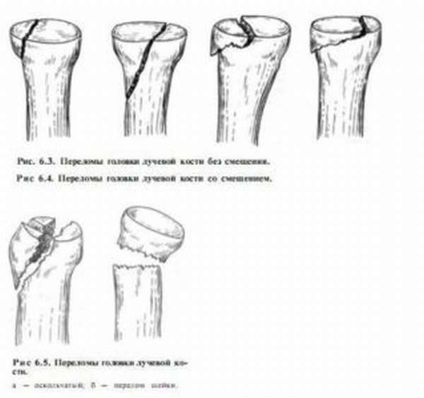 Травматология перелом головки лучевой кости