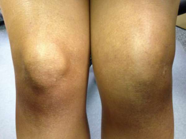 Строение сухожилий и связок коленного сустава