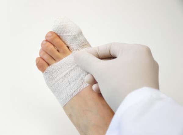 Наложение гипса при переломе пальца ноги