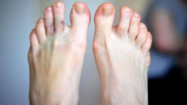 Эластичный бинт при переломе пальца ноги