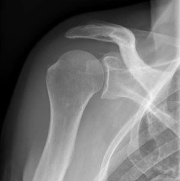 Перелом большого бугорка плечевой кости иммобилизация