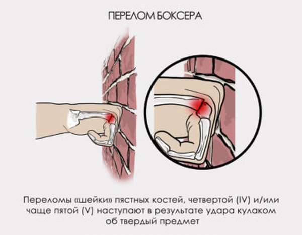 Переломы трещины руки