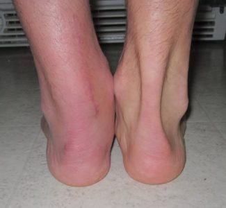 Перелом ноги порваны связки