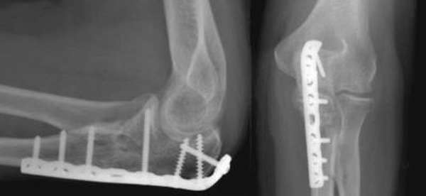 Перелом венечного отростка локтевой кости операция