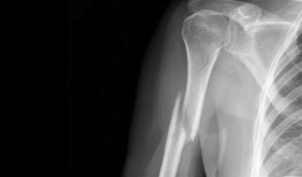 Рентгеновские снимки переломов плеча