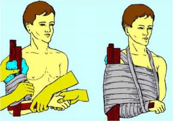 Переломы плечевого сустава человека