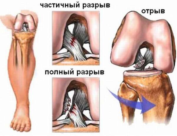 Перелом ноги порваны связки