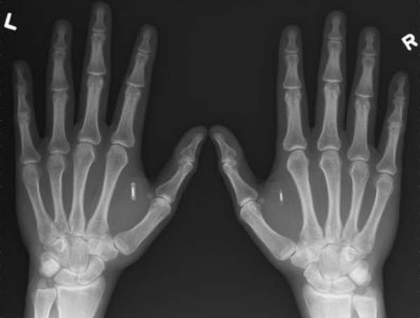 Перелом основания пальца руки