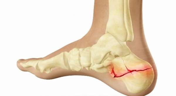 Ортопедический носок при переломе пятки