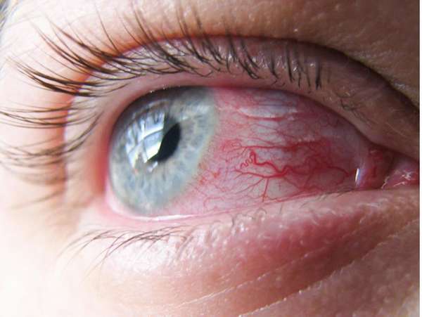 Опухшие глаза: конъюнктивит или инфекция?