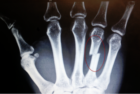 Перелом пястной кости руки симптомы
