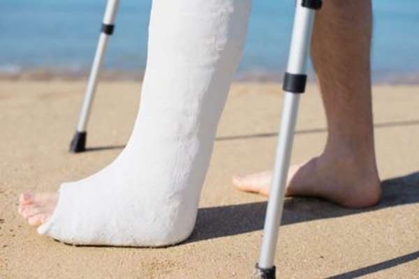 Как накладывать гипс при переломе ноги