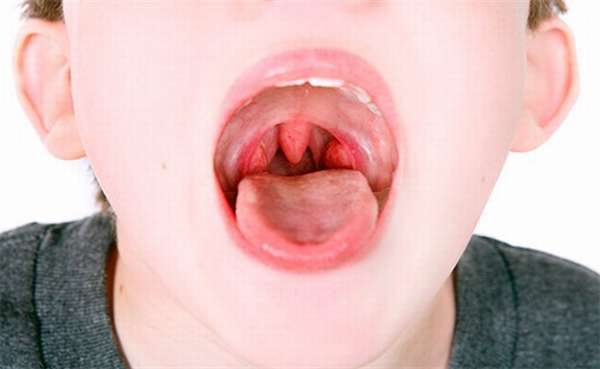 Симптомы воспаления аденоидов у детей