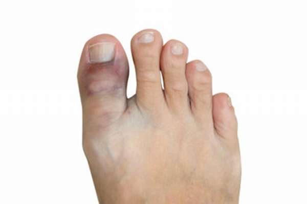 Симптомы вывиха большого пальца ноги